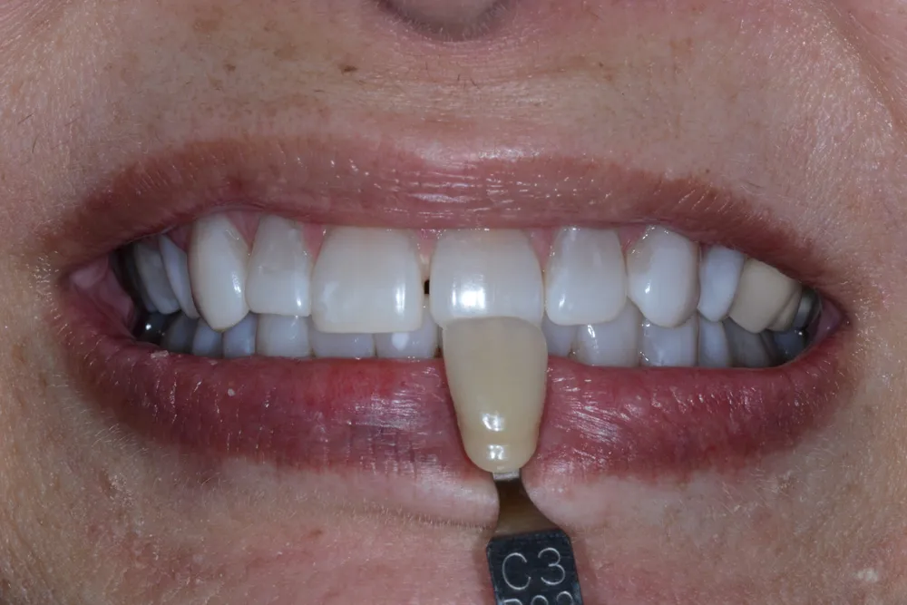 Fort Wayne Dentist Teeth Whitening