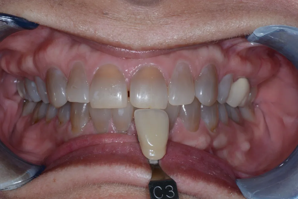 Teeth Whitening Fort Wayne