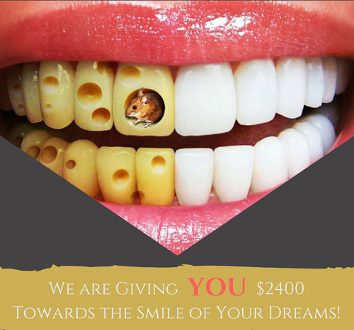 Veneers Special