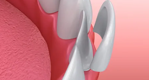Dental Veneers in Novi, MI